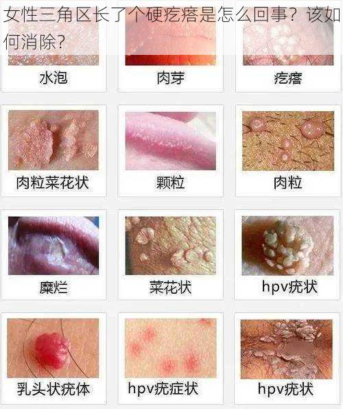 女性三角区长了个硬疙瘩是怎么回事？该如何消除？